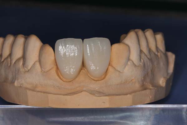 What Is A Dental Crown?