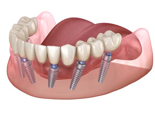 Differences Between Implant Supported Dentures And Traditional Dentures