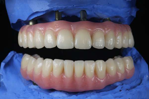 A Brief Comparison Between Implant Supported Dentures And Traditional Dentures